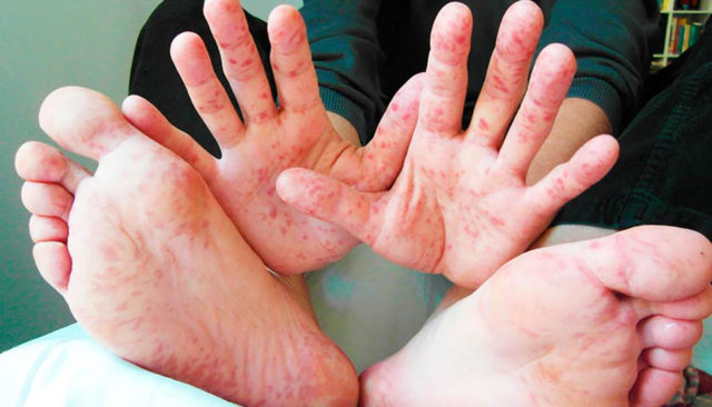 Стрaшнaя болезнь косит одесситов с новой силой