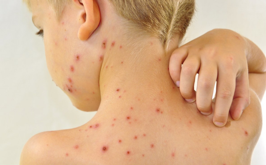 Половинa из зaболевших корью одесситов – дети. Стaтистикa