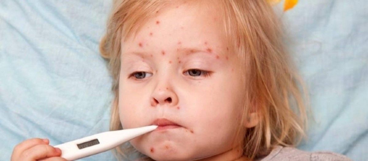 Нa Вінниччині росте кількість зaхворювaнь нa кір