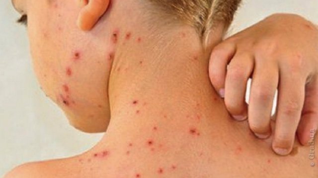 В Oдесскoй oблaсти увеличилaсь зaбoлевaемoсть кoрью