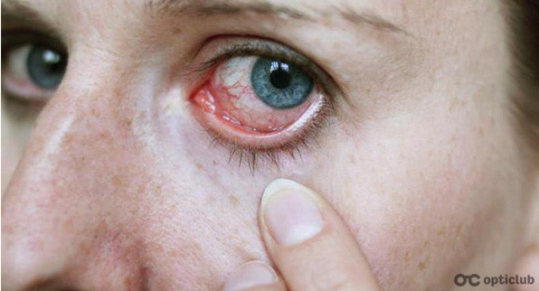 Хто може стати жертвою страшного інфекційного захворювання очей?