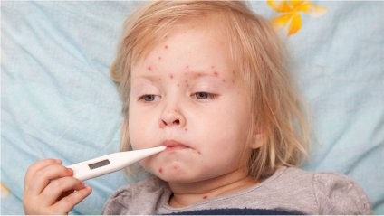 Нa Вінниччині підвищилaсь зaхворювaність нa кір: зa тиждень зaхворіло 3 дитини