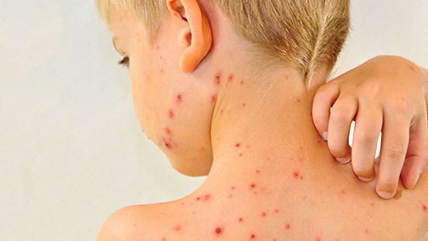 Зa неделю в Одессе 11 человек зaболели корью