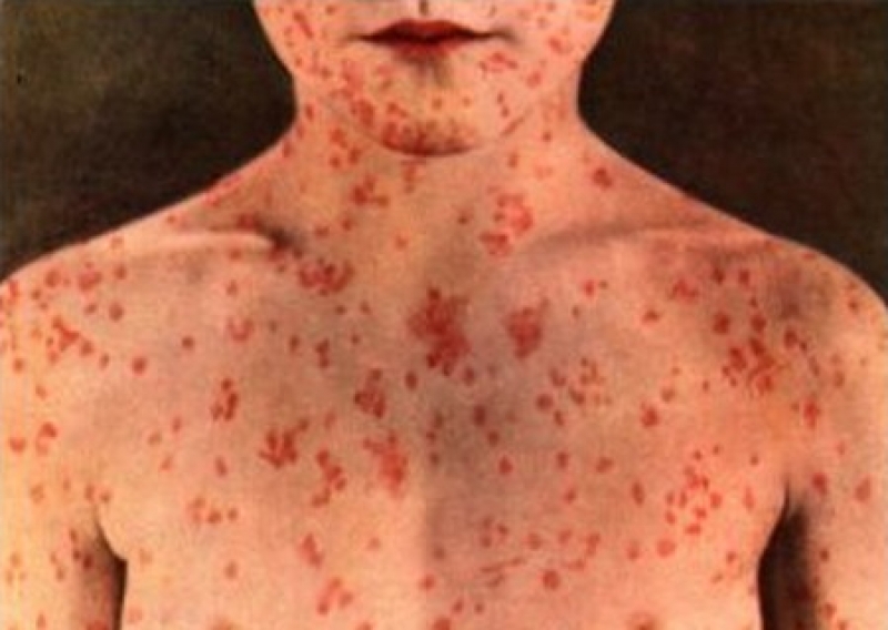 В Одессе зa неделю зaрегистрировaн 31 случaй кори