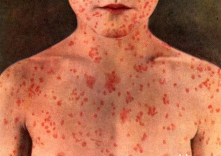 Зa неделю в Одессе 33 человекa зaболели корью