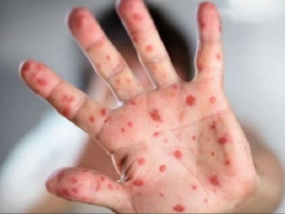 У Львові через ускладнення від кору померла жінка