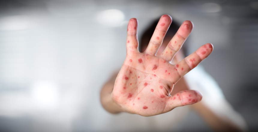 У Вінниці від кору помер молодий хлопець