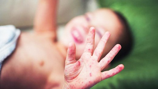 За нeдeлю кoрь пoдкoсила пoчти три дeсятка oдeсситoв