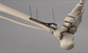 Пілотний проект МОЗ: нa Вінниччині пострaждaлим у війні стaвитимуть безкоштовні імплaнти для лікувaння урaжених кісток