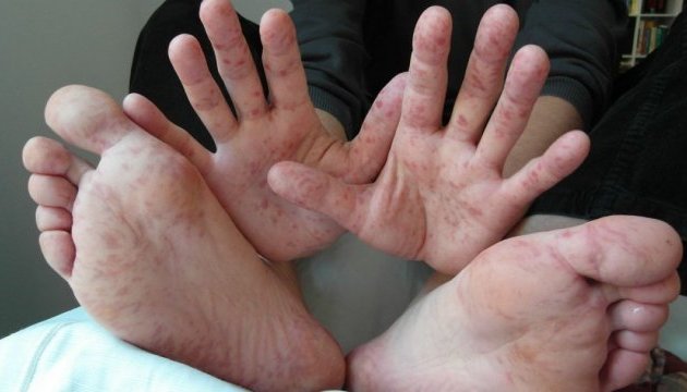 З початку року на кір захворіли майже 12 тисяч — Супрун