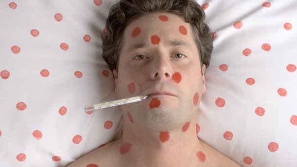 Спалах кору в Запоріжжі набирає обертів