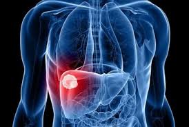 Спалах гепатиту А на Вінниччині: надзвичайна ситуація та заходи міністерства охорони здоров'я