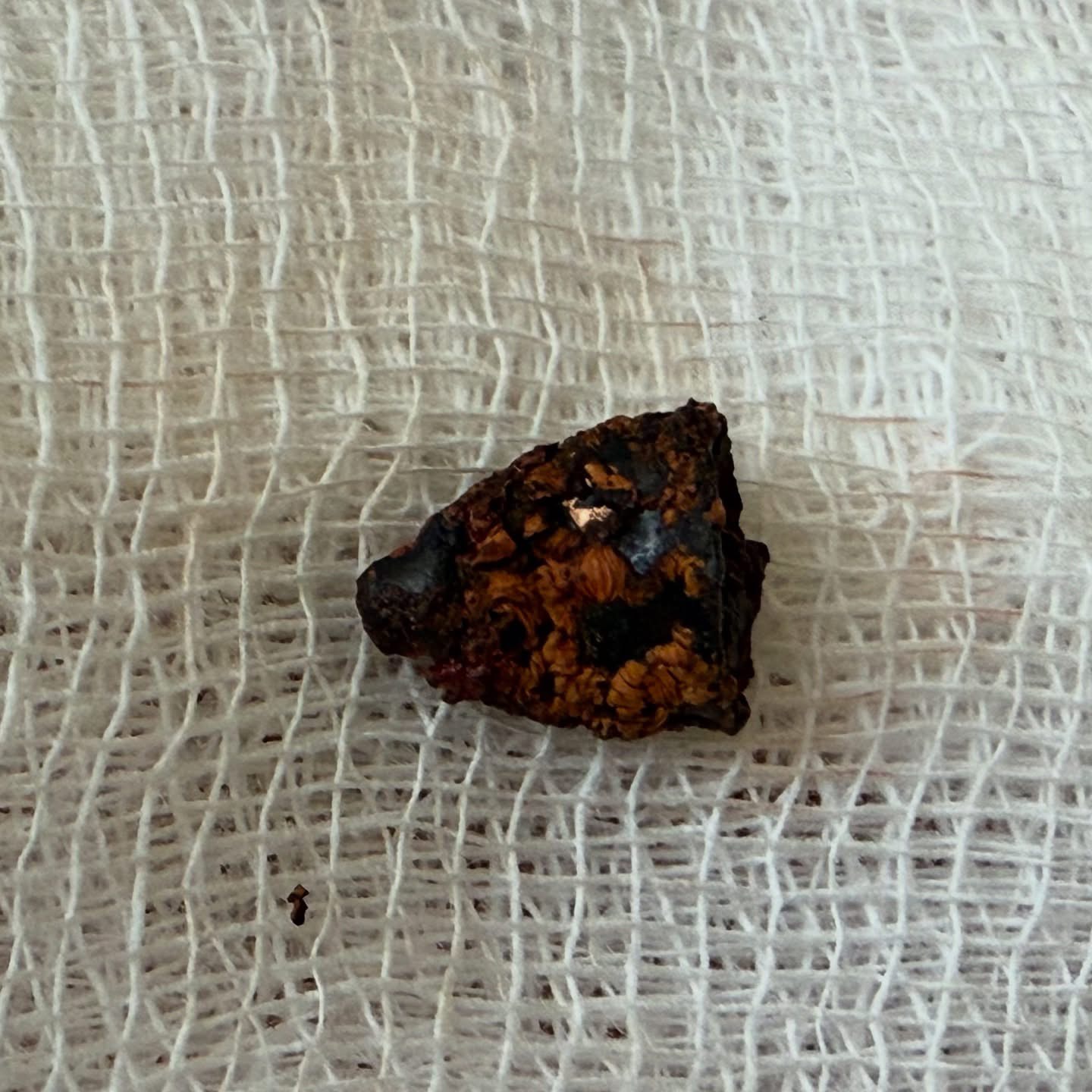 Через три роки після поранення з тіла Героя з Вінниччини дістали сердечник кулі