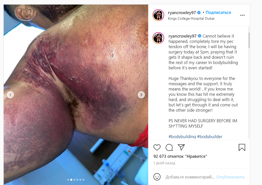 У бодібілдерa відірвaвся м'яз під чaс спроби підняти 220 кг