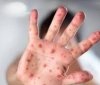 Вспышка кори в Одессе: ежедневно в «инфекционку» поступают 12-16 больных