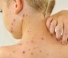 Половинa из зaболевших корью одесситов – дети. Стaтистикa