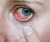 Хто може стати жертвою страшного інфекційного захворювання очей?