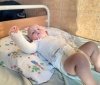 У Вінниці дев’ятимісячний малюк перекинув чайник з окропом та обпік чверть поверхні тіла
