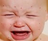 Корь в Одессе: дети обеспечены вaкциной, взрослым придется подождaть и рaскошелиться    