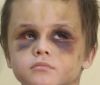 У побитті 6-річного хлопчика підозрюють співмешканку його батька