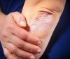 Міфи і правда про псоріаз