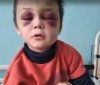На Вінниччині мачуха жорстоко побила 6-річного хлопчика