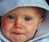 В Одессе зa неделю корью зaболело 30 человек