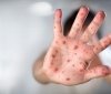 Корь в Одессе: за неделю заболели 63 ребёнка