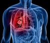 На Вінниччині виявили близько 800 випадків захворювання на туберкульоз