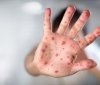 В Україні зафіксували два випадки кору