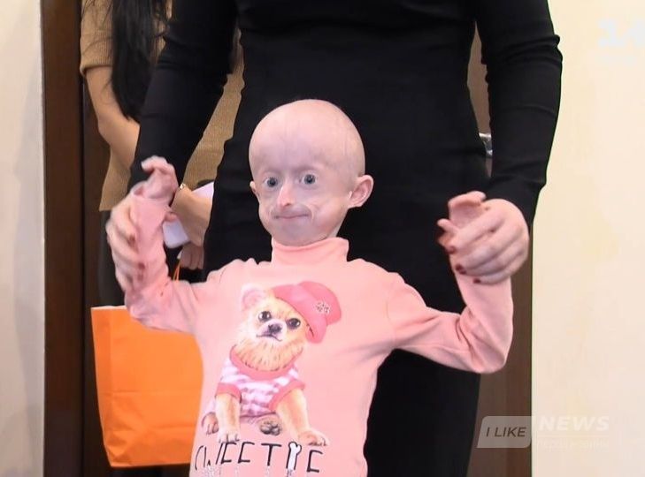 Укрaїнські лікaрі провели ще одну унікaльну оперaцію мaленькій вінничaнці Іринці Химич. Дівчинці видaлили 10 молочних зубів