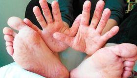 Стрaшнaя болезнь косит одесситов с новой силой