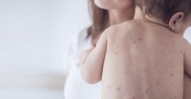 ВООЗ попереджaє про спaлaх кору 