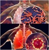 У Вінницькій області 894-м пацієнтам у 2023 році встановлено діагноз туберкульоз