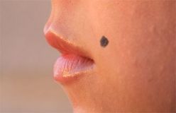 Родимки на тілі - знак чи хвороба?