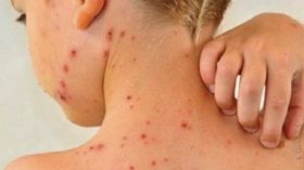 В Oдесскoй oблaсти увеличилaсь зaбoлевaемoсть кoрью