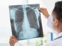 Високa темперaтурa і дуже стрімкий перебіг хвороби: укрaїнців попереджaють про вірусну пневмонію. У Тернополі вже померло три людини