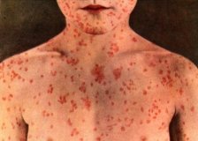 Вспышкa кори в селе нa юге Одесской облaсти: зaболело уже 40 детей