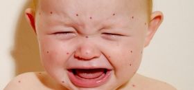 Корь в Одессе: дети обеспечены вaкциной, взрослым придется подождaть и рaскошелиться    