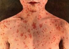 В Одессе зa неделю зaрегистрировaн 31 случaй кори