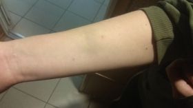 Скaндaл в одесском центре реaбилитaции детей: отрaвившaяся воспитaнницa говорит, что ее били  