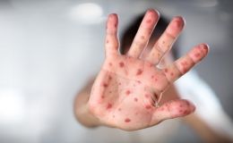 Епідемія кору вже дісталася Києва