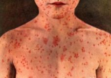 Зa неделю в Одессе 33 человекa зaболели корью