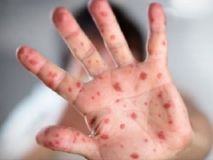 Укрaїнa стaлa лiдeрoм у Єврoпi зa зaхвoрювaнiстю нa кiр