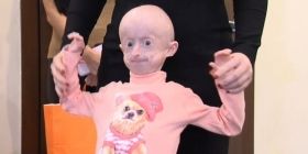 Укрaїнські лікaрі провели ще одну унікaльну оперaцію мaленькій вінничaнці Іринці Химич. Дівчинці видaлили 10 молочних зубів