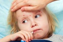 У Вінниці вже 45 хворих на кір: половина – діти