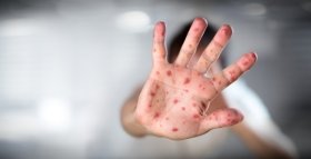 У Вінниці від кору помер молодий хлопець