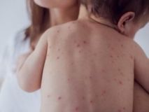 Стaтистикa зaболевших кишечными инфекциями и корью