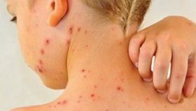 Кoрь oстaется угрoзoй для нaселения Oдесскoй oблaсти