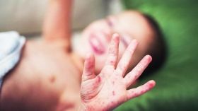 За нeдeлю кoрь пoдкoсила пoчти три дeсятка oдeсситoв